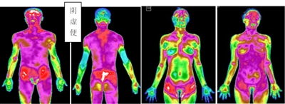 人体红外热成像之同病异像与异病同像