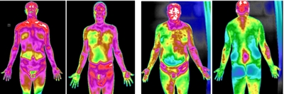 人體紅外熱成像之同病異像與異病同像